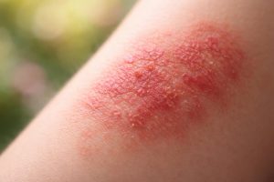 peau-eczema-irritee-flou-couleurs